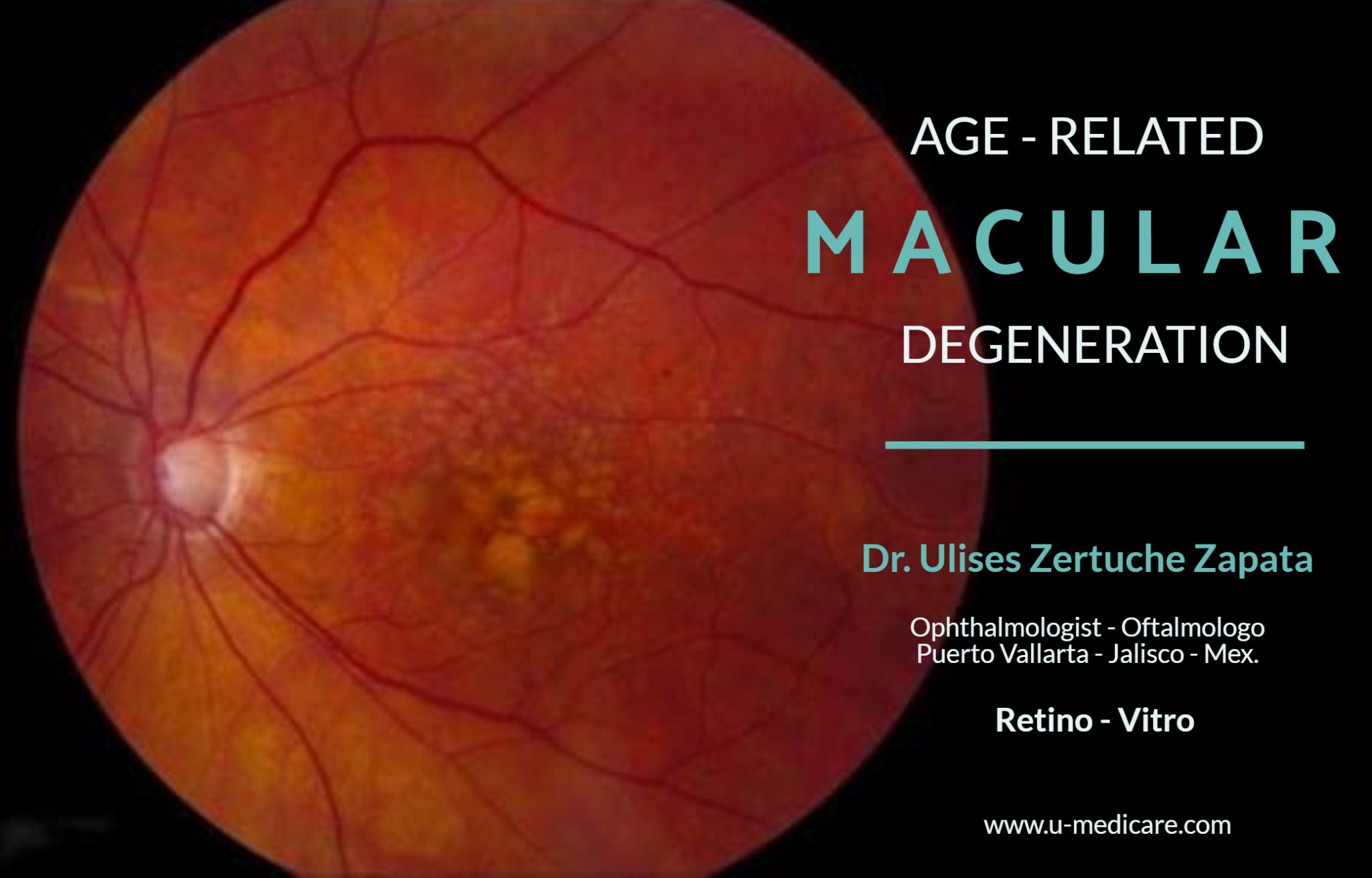 Age-related Macular Degeneration (AMD) Treatment Puerto Vallarta